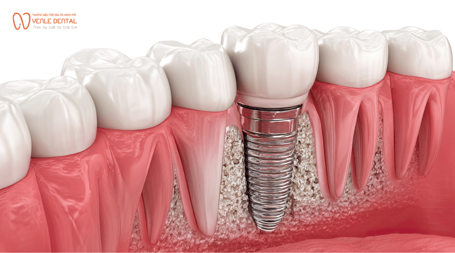 răng implant khó dịch chuyển